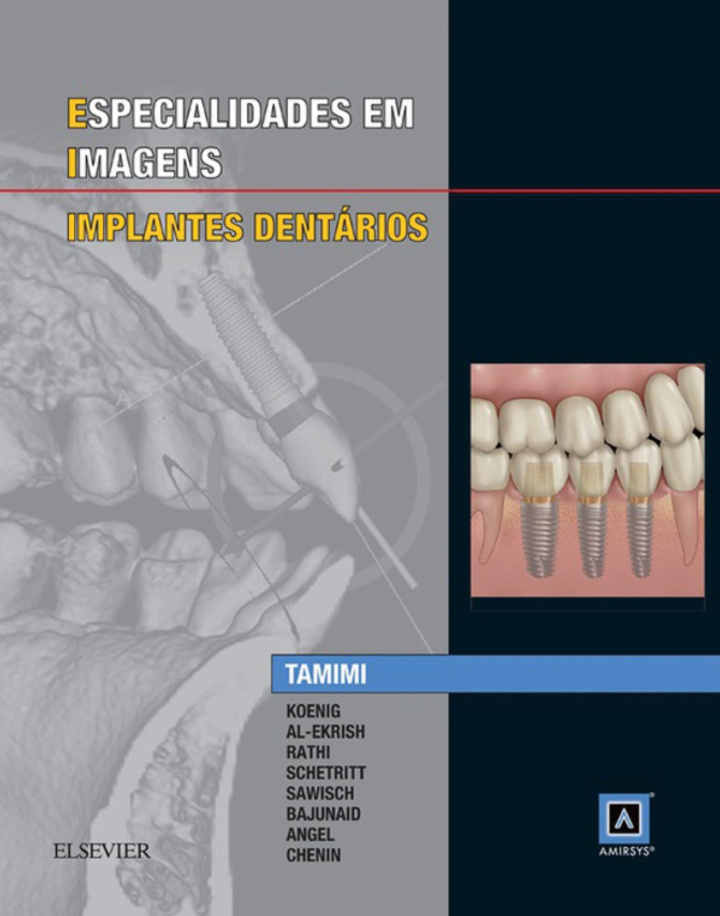 Especialidades em Imagens: Implantes Dentarios