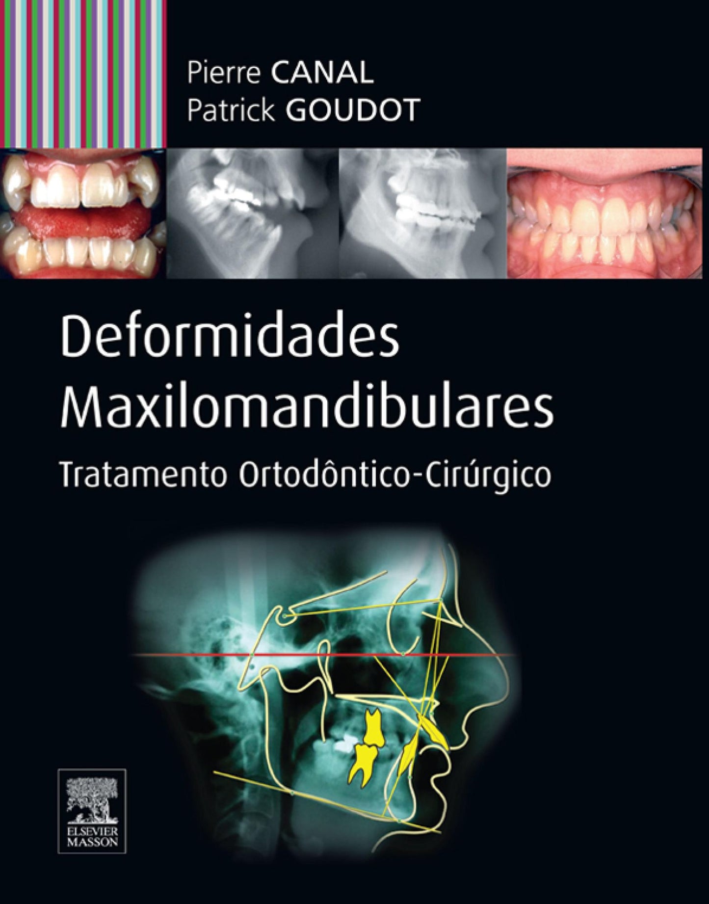 Deformidades Maxilo-mandibulares: Tratamento Ortodôntico -cirúrgico