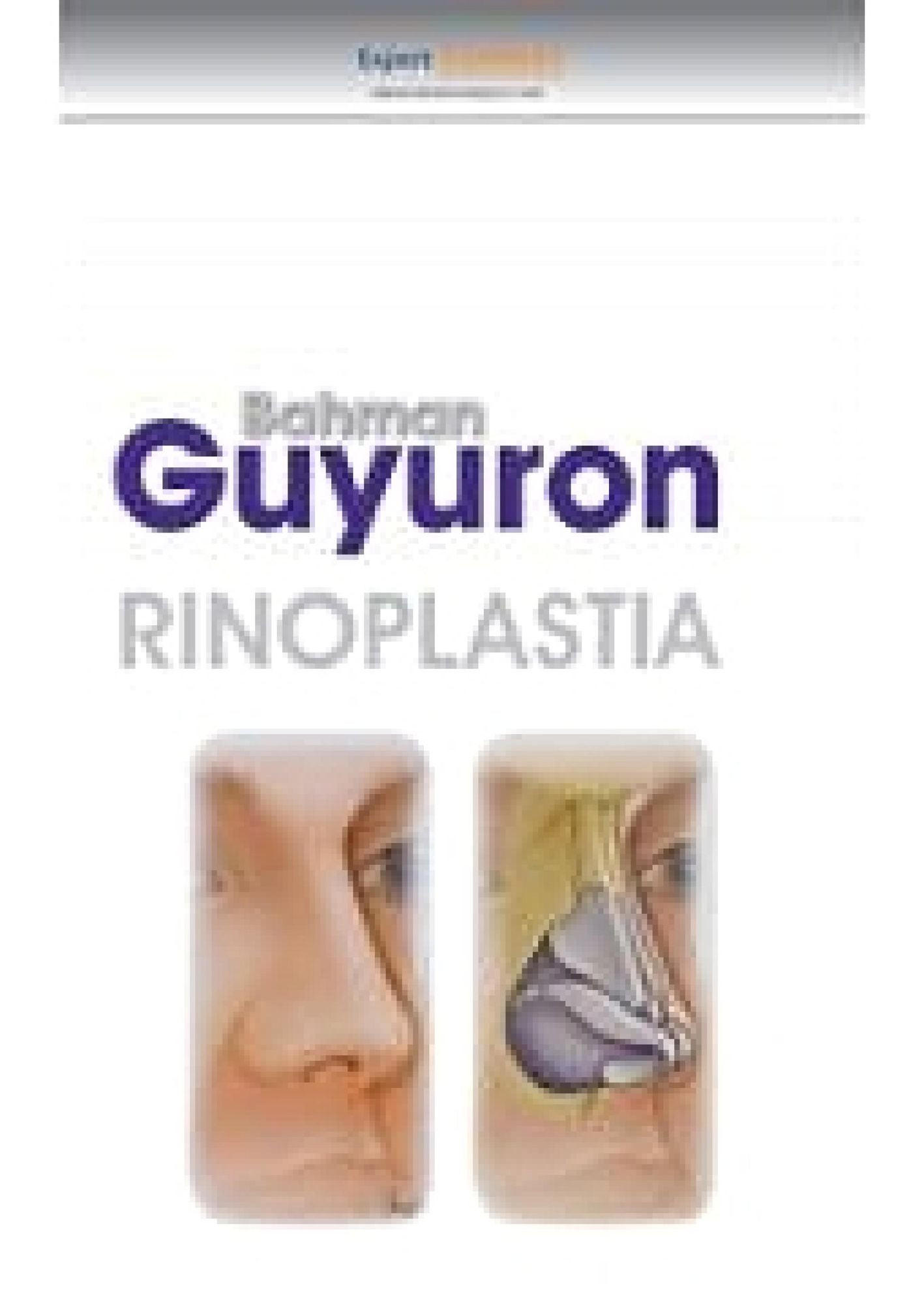 Rinoplastia