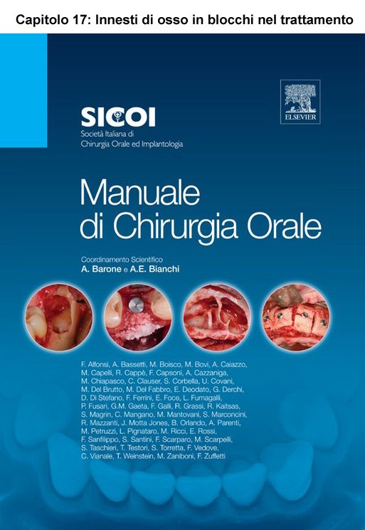 Innesti di osso in blocchi nel trattamento delle creste alveolari atrofiche