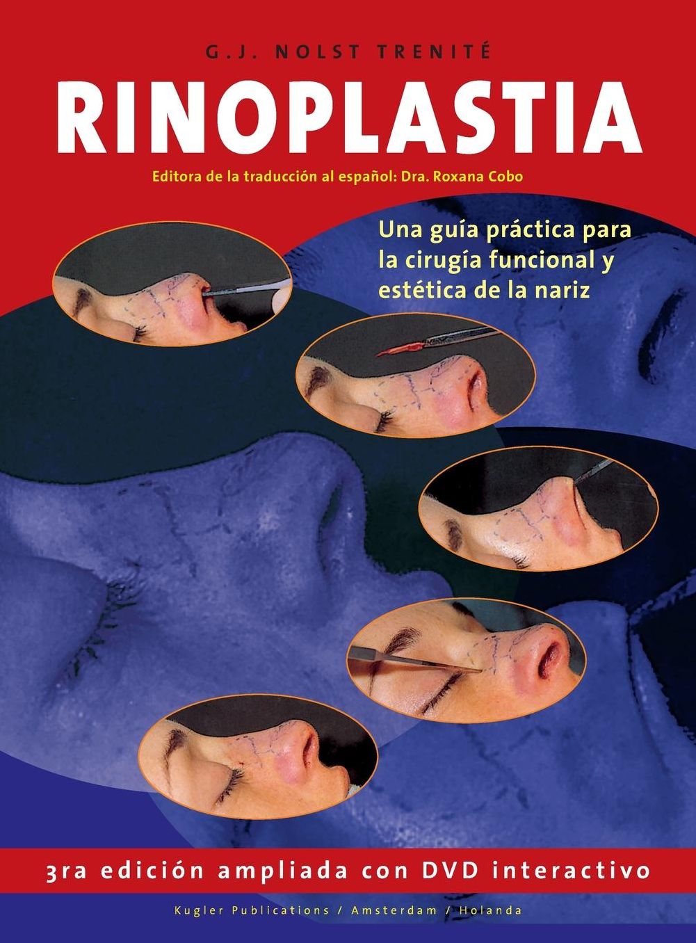 Rinoplastia
