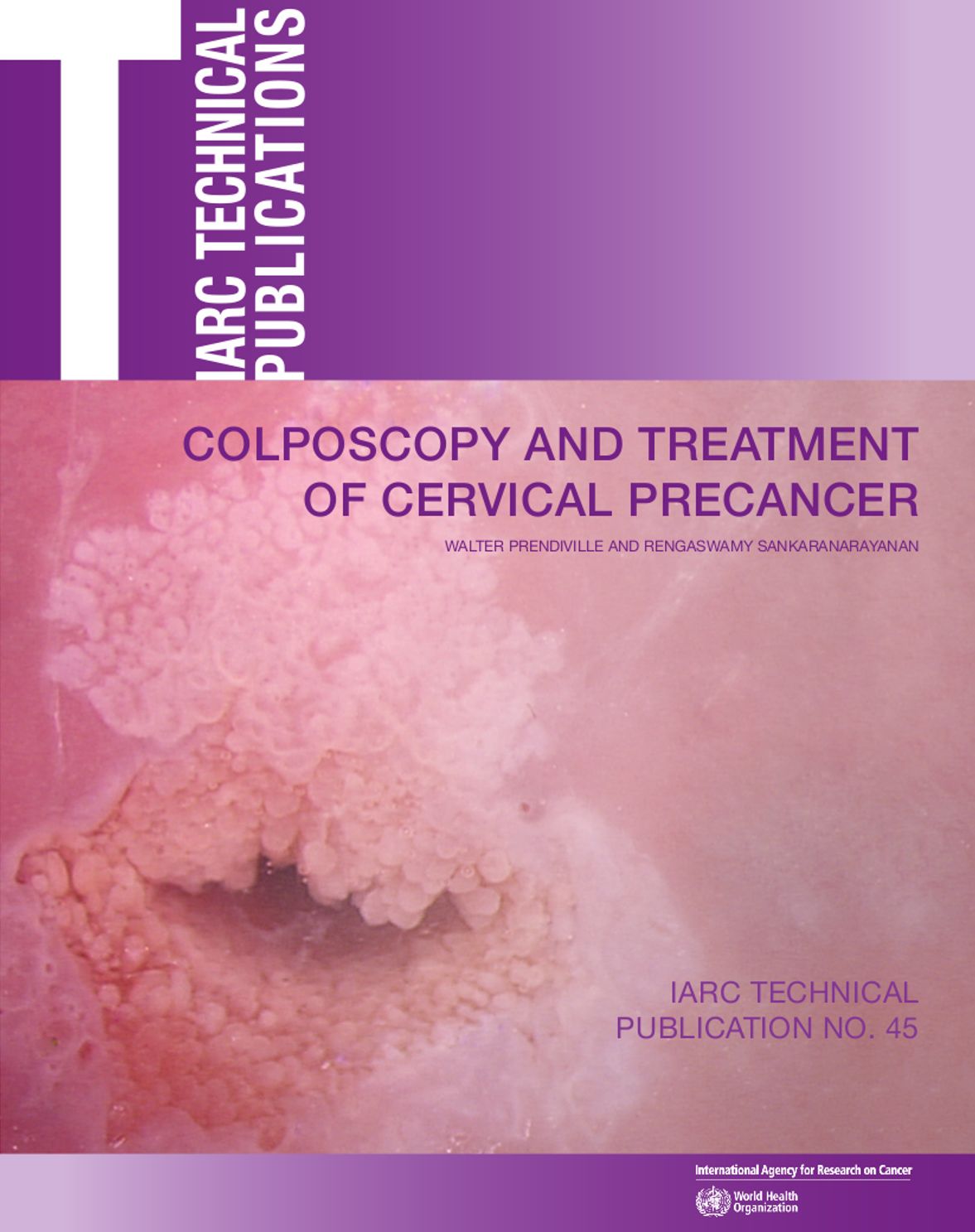 Colposcopy and Treatment of Cervical Precancer