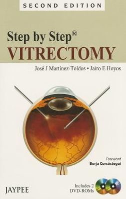 Step by Step: Vitrectomy