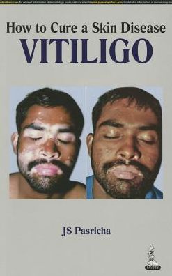 How to Cure a Skin Disease: Vitiligo