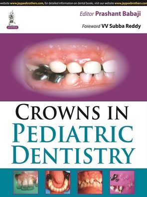 Crowns in Pediatric Dentistry