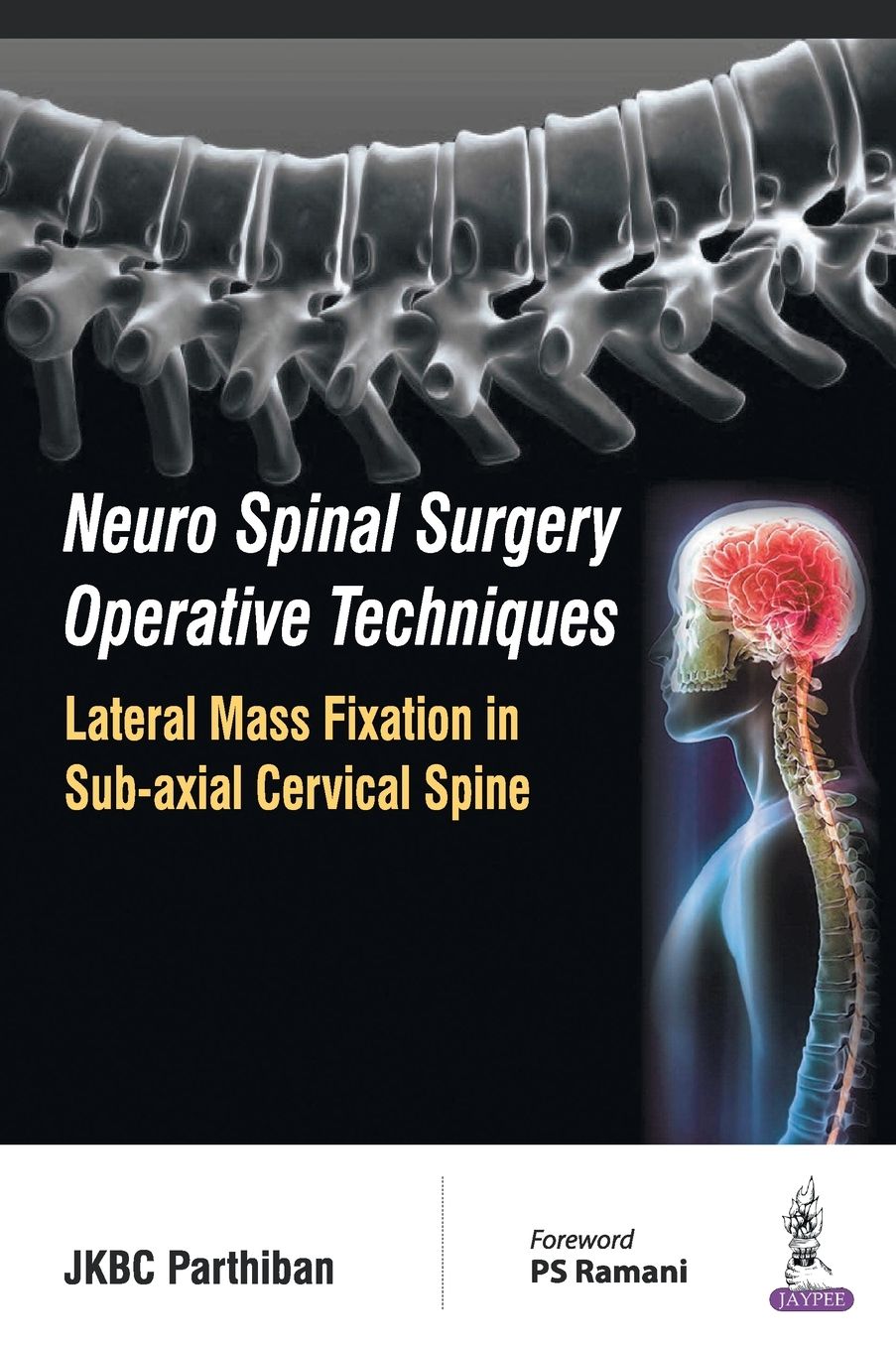 Neuro Spinal Surgery Operative Techniques : Lateral Mass Fixation in Sub-axial Cervical Spine