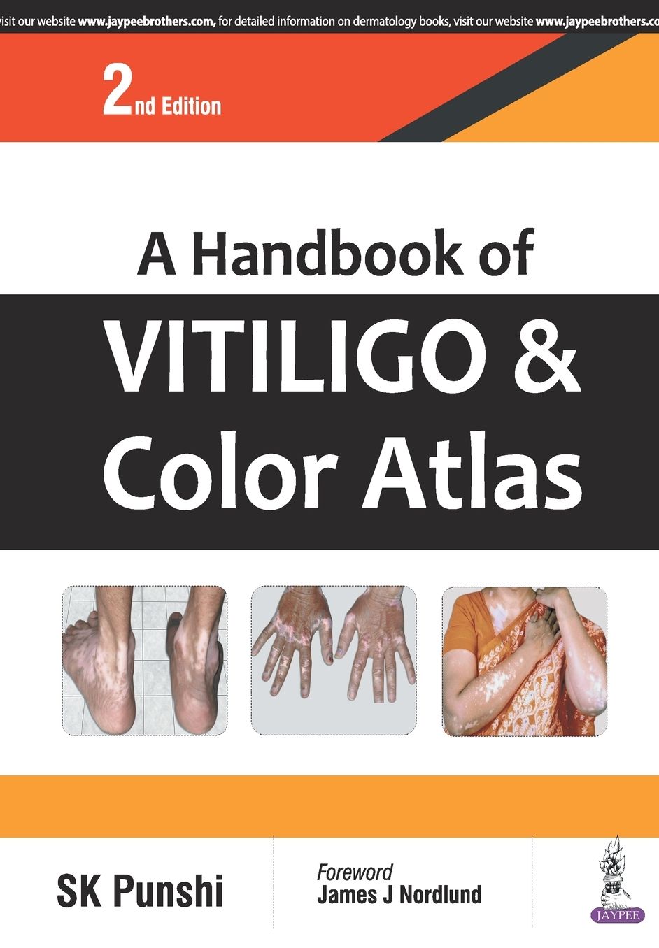 A Handbook of Vitiligo and Colour Atlas