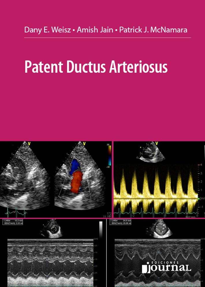 Patent Ductus Arteriosus